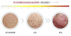 黑头粉刺如何快速祛除