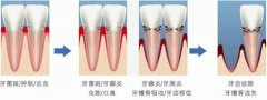 牙周炎有哪些危害<