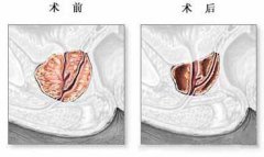 前列腺增生挂什么科