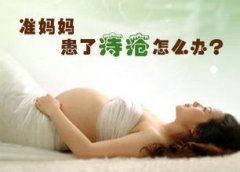 孕期女性应该怎样治疗痔